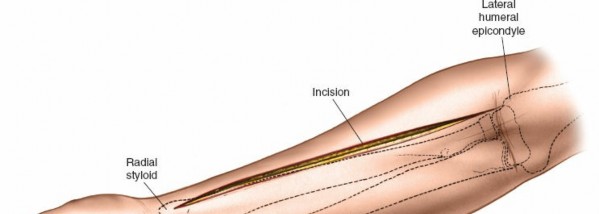 Mastering the Treatment of Forearm Compartment Syndrome