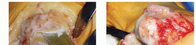 Illustration 5 for Mastering Extensive Plantar Release for Hallux Rigidus