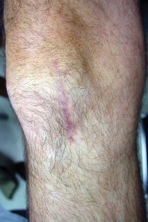 Illustration 24 for Knee Arthroplasty: Avoiding Pitfalls & Benefiting from UKA