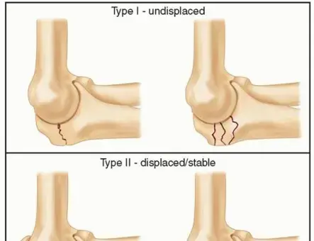 كسور عظمة الزند القريبة: دليل شامل للمرضى لاستعادة قوة المرفق في اليمن والخليج