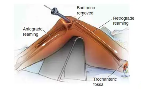 Illustration of knee arthrodesis knee - Dr. Mohammed Hutaif