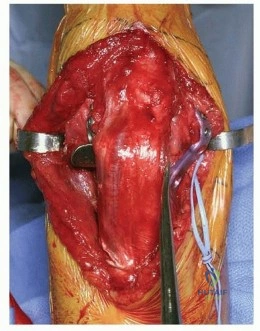 Illustration 9 for Optimizing ORIF for Distal Humerus: Prevent Class II HO