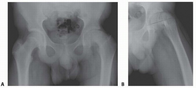 Illustration of flexion intertrochanteric osteotomy - Dr. Mohammed Hutaif