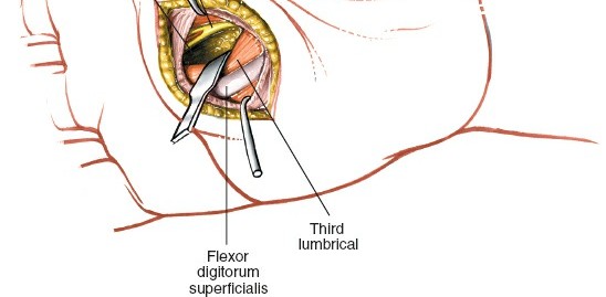 Image illustrating the careful dissection of digital nerves