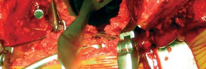 صورة طبية: طول عمر مكون الحُق الأسمنتي في مفصل الورك: مفتاح الاستقرار والديمومة مع الأستاذ الدكتور محمد هطيف في صنعاء