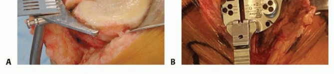 Illustration 12 for Achieve Lasting Pain Relief with Cemented Total Knee Arthroplasty