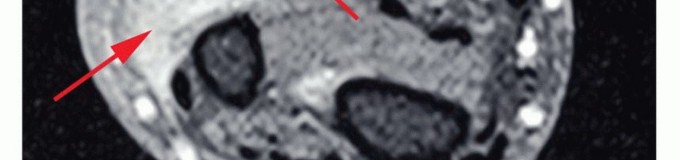 صورة توضيحية لأشعة سينية تظهر ورمًا عظميًا يتطلب بترًا