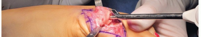 Illustration 28 for End Articular Cartilage Loss: Arthrosurface HemiCAP Resurfacing