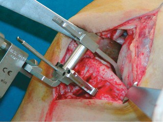 Illustration 37 for Unicompartmental Knee Arthroplasty: Master decisions with this b c figure guide.