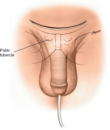 Anterior Approach to the Pubic: Your Surgical How-To Guide