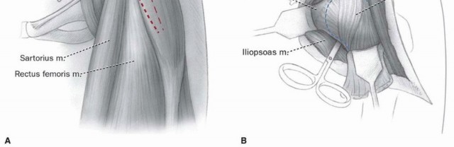 Illustration 9 for Periacetabular Osteotomy: Realigning your hip via the superior pubic ramus