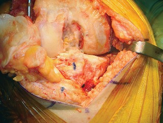 Illustration 23 for Mastering TKA: Essential Methods of Rotational Alignment