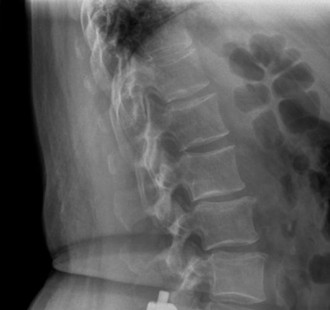 Illustration 4 for Adjacent Segment Degeneration: Your Next Spine Case Solved