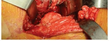 Illustration 4 for Total Hip Arthroplasty: Posterolateral Approach, Extensile & Minimally Invasive