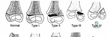 Illustration of fractures and dislocations - Dr. Mohammed Hutaif