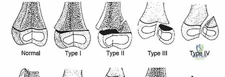 Illustration of fractures and dislocations - Dr. Mohammed Hutaif