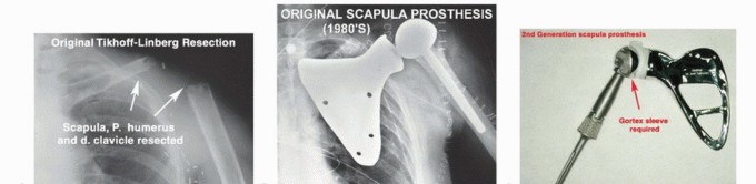 Mastering Total Scapular Resections: Reconstruction & Outcomes