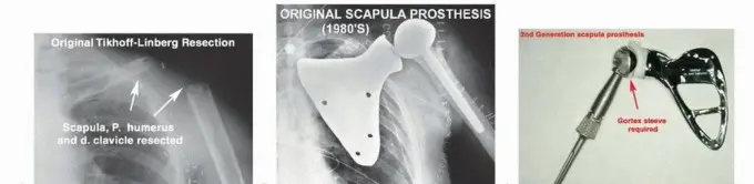 صورة توضيحية لـ الاستئصال الكلي للوح الكتف: دليل شامل للمرضى حول الجراحة، إعادة البناء والنتائج مع الأستاذ الدكتور محمد هطيف في صنعاء