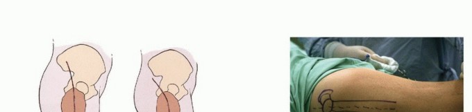 Illustration 16 for Beyond Amputation: Total Femur Resection with Endoprosthetics