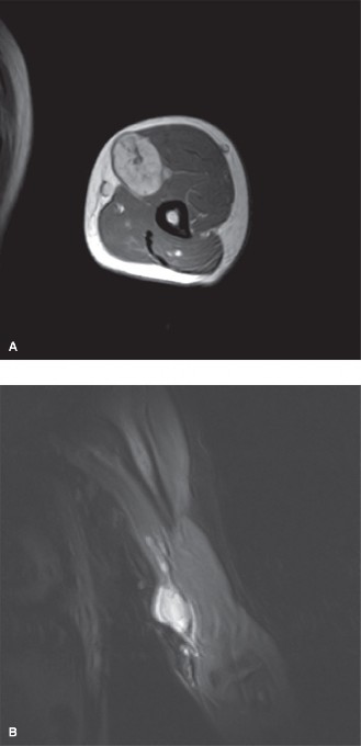 Solving Complex Orthopedic Oncology Cases Schwannoma