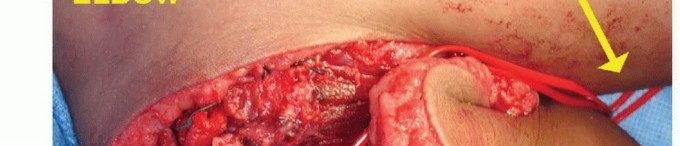 صورة طبية: استئصال الجزء البعيد من عظم العضد: تقنيات آمنة للحفاظ على الطرف في صنعاء مع الأستاذ الدكتور محمد هطيف