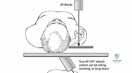 Illustration of anterior glenohumeral dislocation - Dr. Mohammed Hutaif
