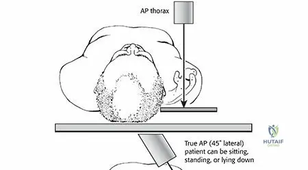 Anterior Glenohumeral Dislocation: Comprehensive Guide to Epidemiology, Anatomy, & Mechanisms