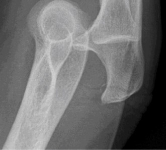 Illustration 63 for Right Shoulder Pain? Avoid This Common X-ray Mistake.