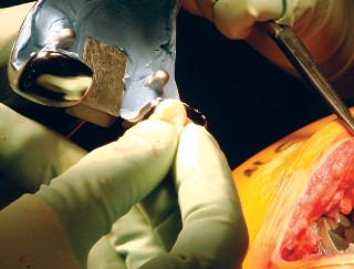 Illustration 36 for Cemented TKA Figure: Your Visual Guide to Surgical Success