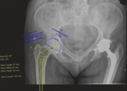 Illustration 5 for Hybrid Primary Total Hip: A Solution for Complex Joint Pain