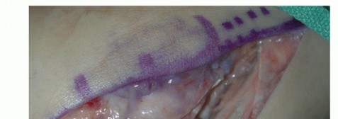 Illustration 34 for Beyond Primary Repair: Solutions for Peroneal Tendon Subluxation