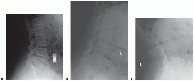 Mastering Posterolateral Thoracolumbar Fusion with Instrumentation