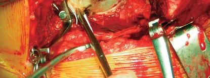 صورة طبية: طول عمر مكون الحُق الأسمنتي في مفصل الورك: مفتاح الاستقرار والديمومة مع الأستاذ الدكتور محمد هطيف في صنعاء