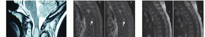Illustration of intradural extramedullary tumors - Dr. Mohammed Hutaif
