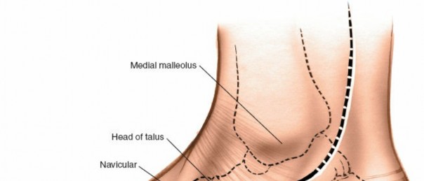 Mastering Dorsal Approaches to the Middle Part of the Foot
