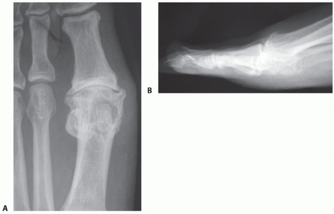 Illustration 2 for MTP Joint Arthrodesis: The Key to Optimal Toe Positioning