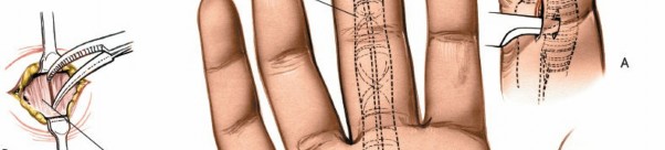 Illustration 214 for Essential Surgical Approaches: Uncover Every Aspect of the Wrist