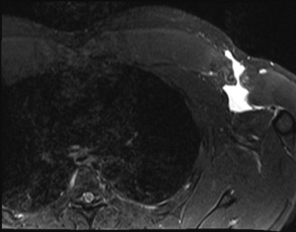 Illustration 56 for Right Shoulder Pain? Avoid This Common X-ray Mistake.