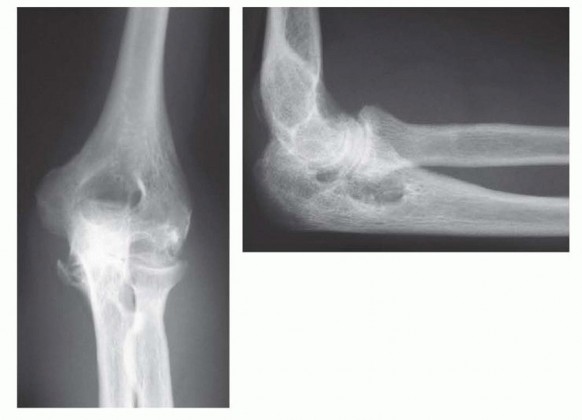 Total Elbow Arthroplasty for Rheumatoid Arthritis