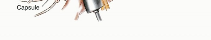 Illustration 35 for Beyond Amputation: Total Femur Resection with Endoprosthetics