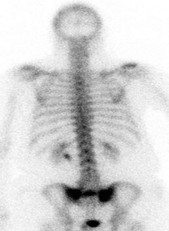 Diagnose Sacral Insufficiency Fractures When X-Rays Fail