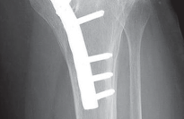 Illustration 2 for Optimize Tibial Component Alignment: Techniques for TKA Success
