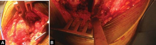 صورة طبية: استبدال مفصل الورك الكلي لالتهاب المفاصل الروماتويدي اليفعي: استعادة الحركة والأمل مع الأستاذ الدكتور محمد هطيف في صنعاء