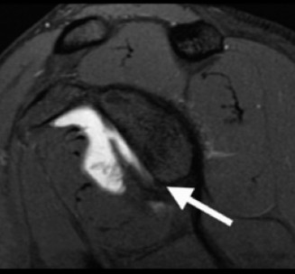 Illustration 8 for Right Shoulder Pain? Avoid This Common X-ray Mistake.