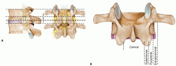Disc herniations