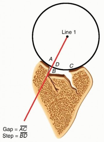 Corrective Osteotomy for Distal Radius Malunion