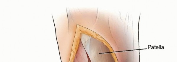 Illustration 9 for High Tibial Osteotomy: Realignment for Lasting Knee Pain Relief
