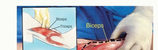 صورة توضيحية لـ استئصال الجزء البعيد من عظم العضد: تقنيات آمنة للحفاظ على الطرف في صنعاء مع الأستاذ الدكتور محمد هطيف