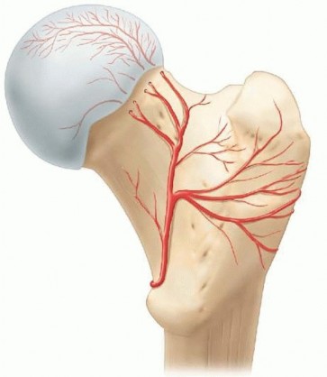 Optimizing Slipped Capital Femoral Correction: Modified Dunn