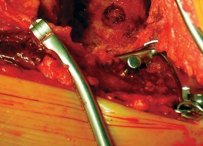 صورة طبية: طول عمر مكون الحُق الأسمنتي في مفصل الورك: مفتاح الاستقرار والديمومة مع الأستاذ الدكتور محمد هطيف في صنعاء